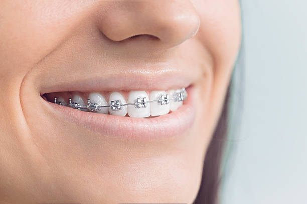 Best Veneers and Lumineers  in South Pasadena, FL